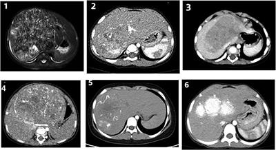 Surgical treatment of postoperative intractable bile leakage after liver tumor surgery in children